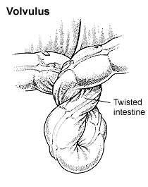 Volvulus complete twisting of a loop of bowel around its mesentery Sites: sigmoid caecum small bowel (all