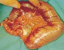 Atresia & Stenosis Pathology imperforate mucosal diaphragm