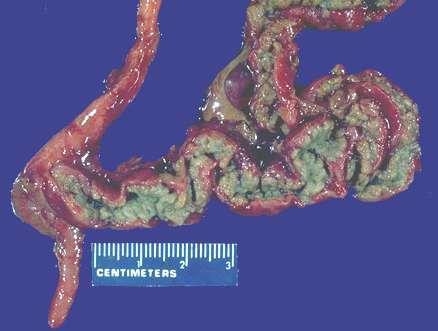 hardened meconium in the gut mucoviscidosis of pancreas born