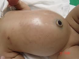 Neonate with vomiting & abdominal distension Mom 25 y.o., primigravid Good prenatal care Normal