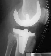 Stiffness after total knee arthroplasty: prevalence of the complication and outcomes of revision.
