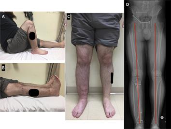 Results In comparison with classic bone transport (using external fixation alone), our technique involves a similar number of surgical procedures to complete the tibial reconstruction as well as a