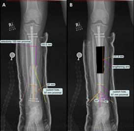 Step 2: Proximal Tibial Osteotomy for Lengthening In the planned location, perform the tibial osteotomy prior to insertion of the intramedullary nail (Fig. 4).