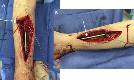 Step 3: Insertion of the Intramedullary Nail Prepare the nail path by reaming the medullary canal of the tibia.