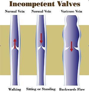 Love your legs again Varicose Veins Veins are the vessels that return blood to the heart once it has circulated through the body (as opposed to arteries, which carry oxygen-rich blood from the heart