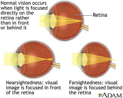 Nearsightedness vs farsightedness Figure 3. Normal, nearsightedness, and farsightedness.