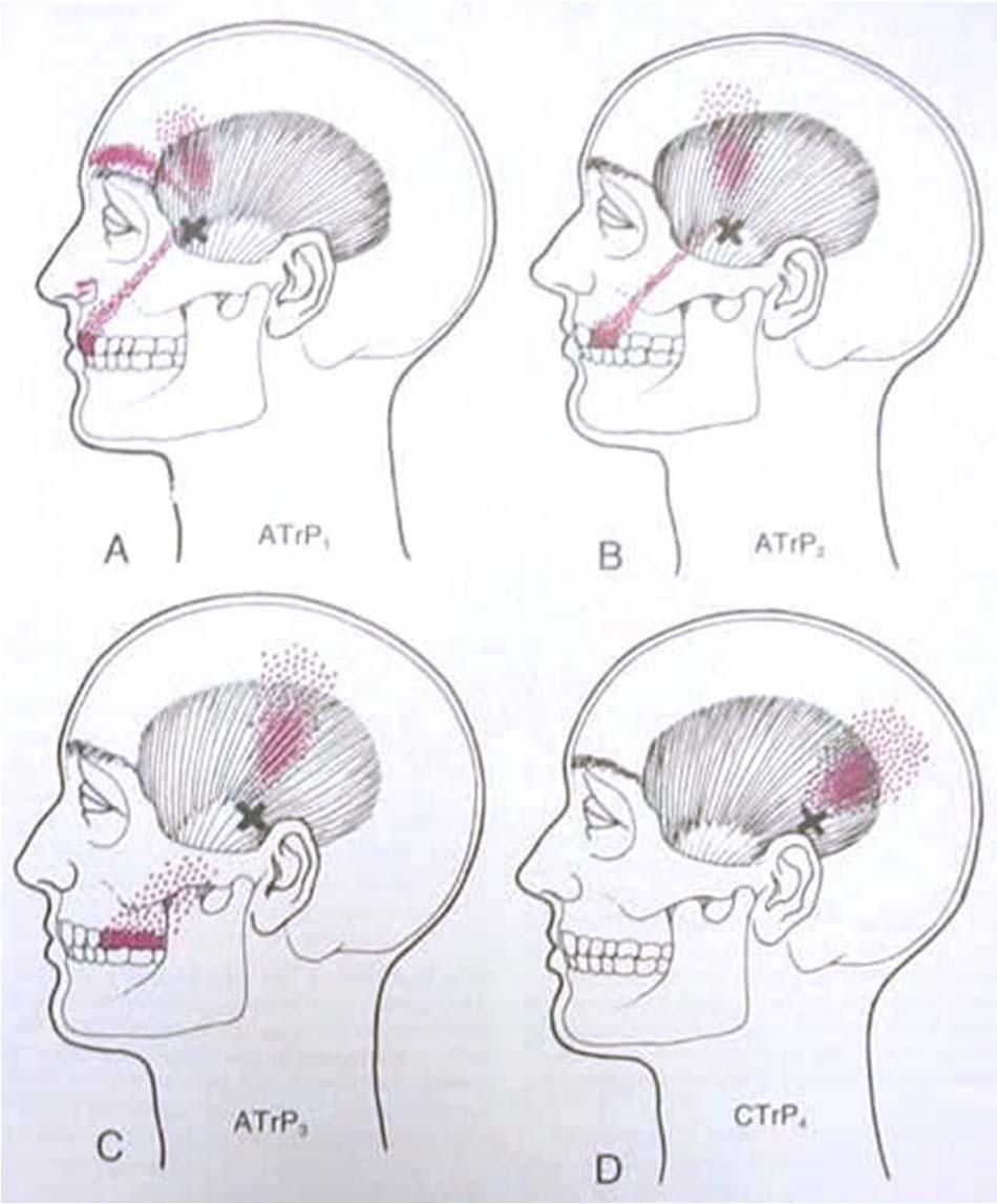 20 Temporalis Images courtesy