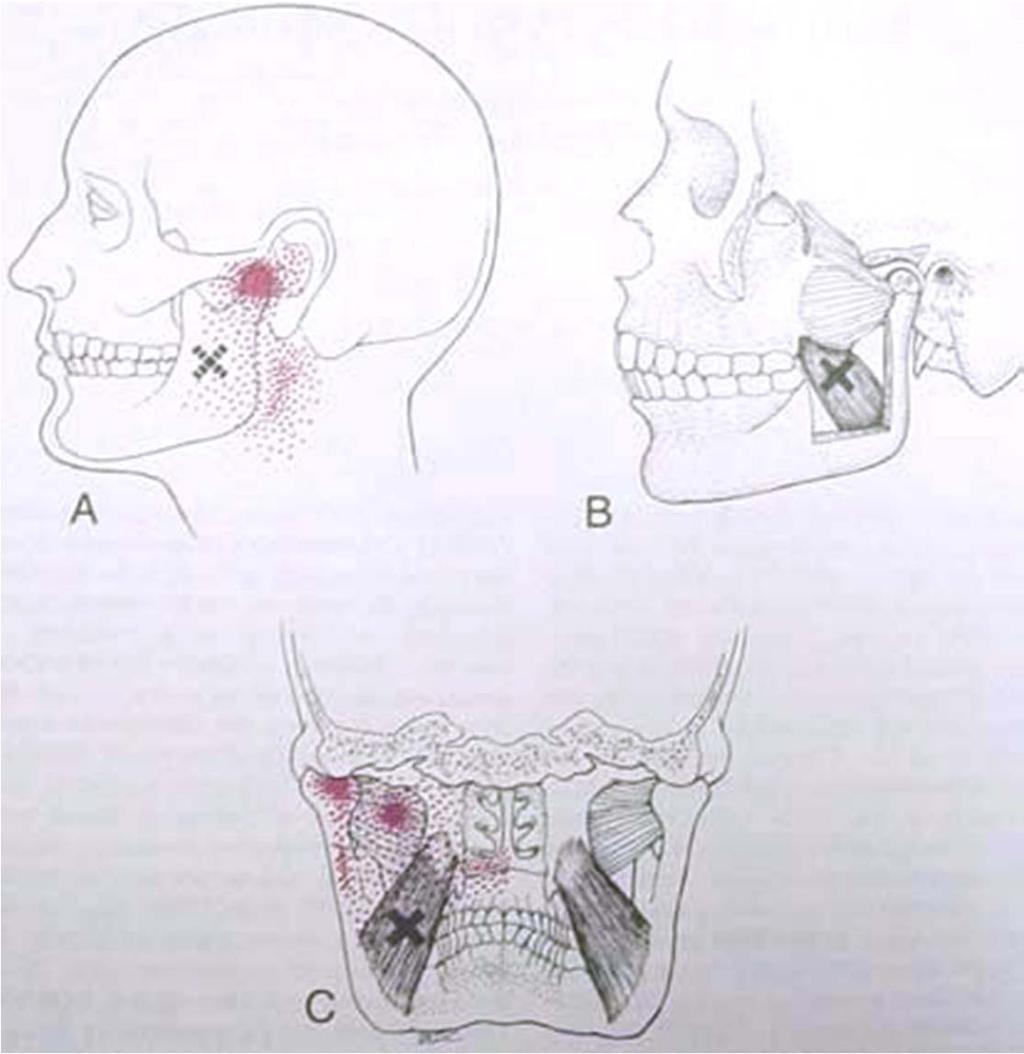22 Medial Pterygoid Images