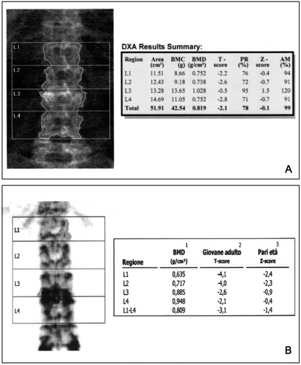 Fig. 3: The presence of artifacts may alter bone mineral density (BMD) and T-score. (A) The presence of spine stabilization needles over L2 elevate BMD.