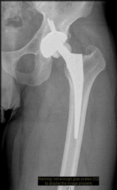 Diagnosis: Ceramic head fracture In the 1970 s, Boutin implemented ceramic in modern total hip arthroplasty (THA). Although initial fracture rates of 13.