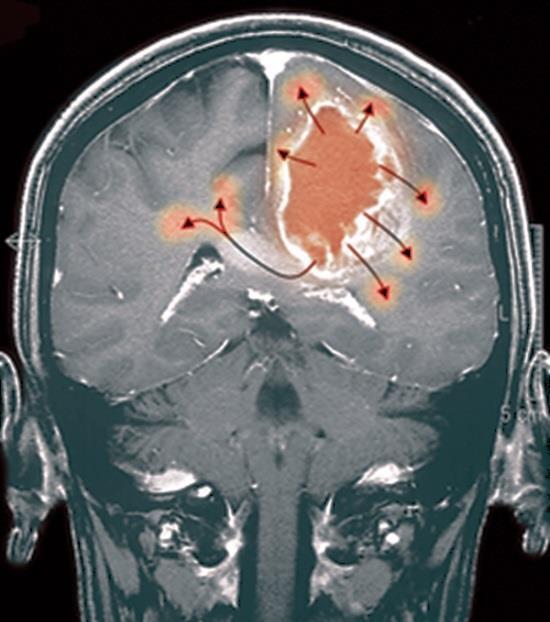 Aggressive cancers: Clinical indication & need Our current focus is on Glioblastoma Median survival of 14.