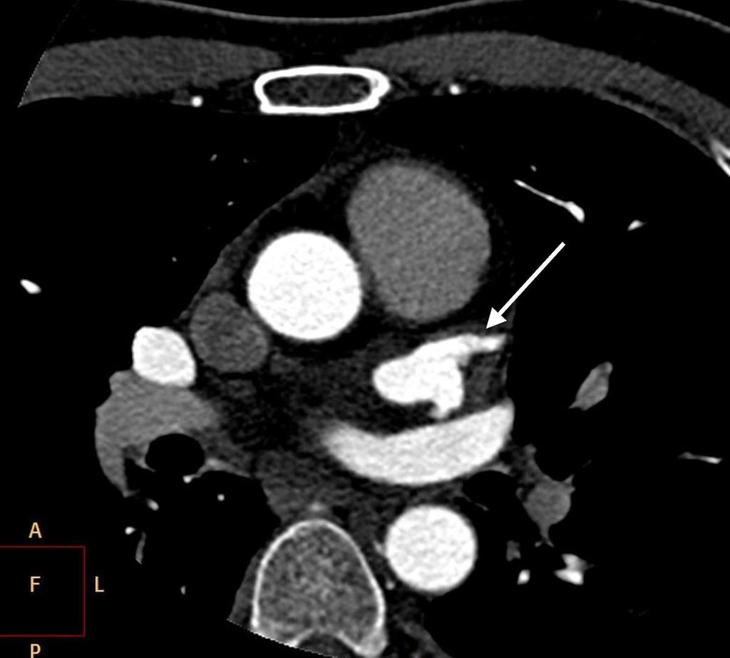 Fig. 4: Typical appearance of left atrial appendage(white arrow):