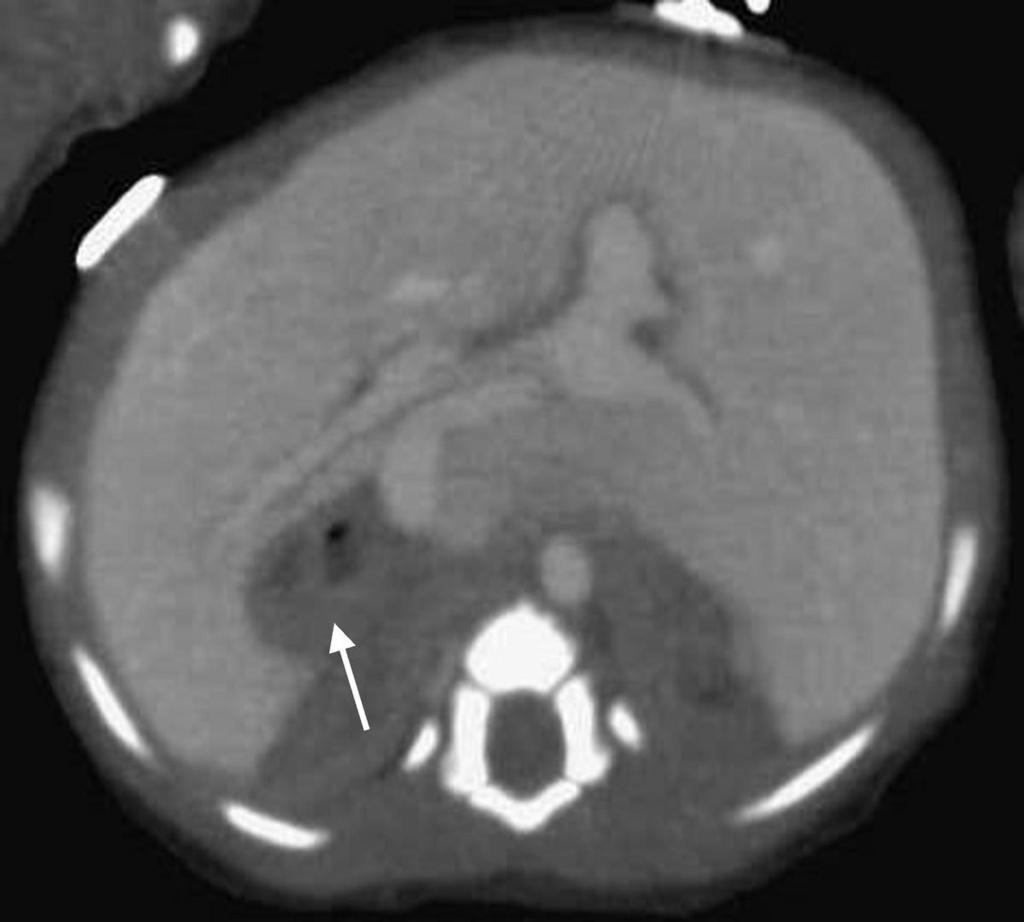Fig. 7: A 1 month old girl with huge transverse liver and right side stomach(white arrow).