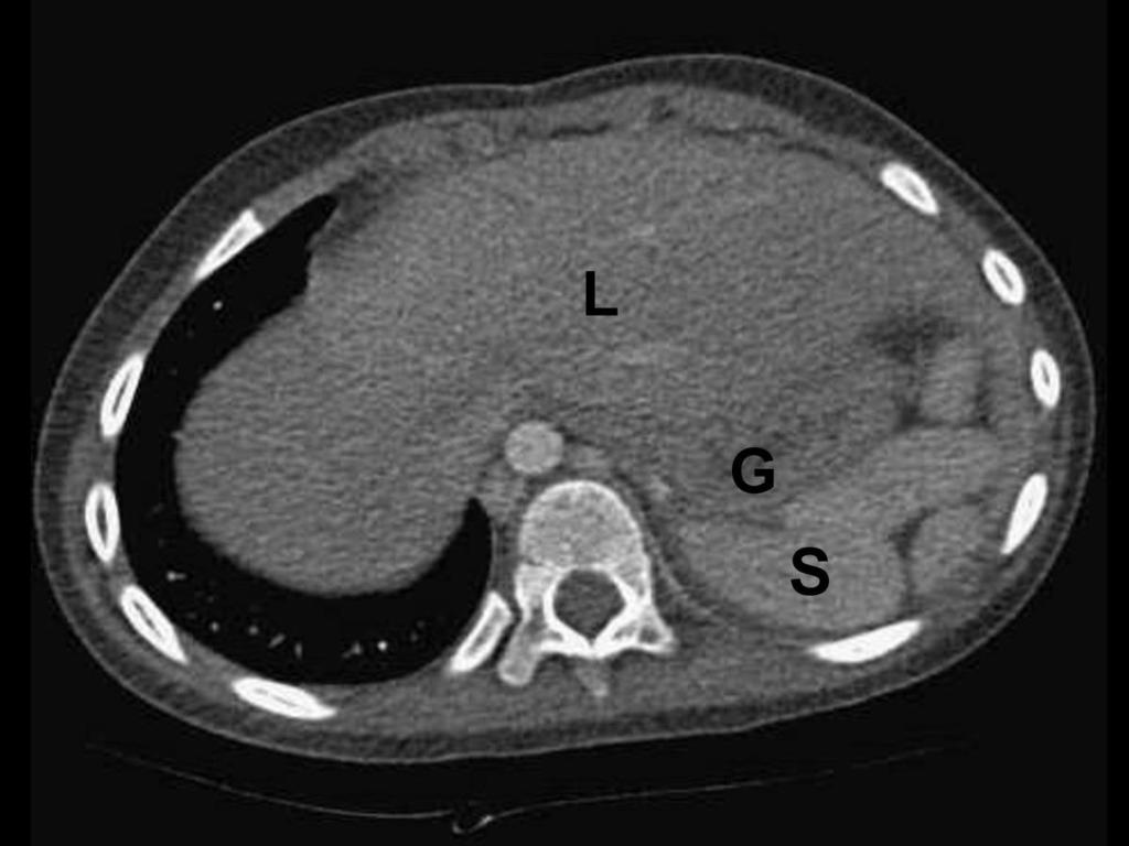 Fig. 9: This 5 day old boy has largest lobe of liver(l) at right side with stomach(g) and spleen(s) at