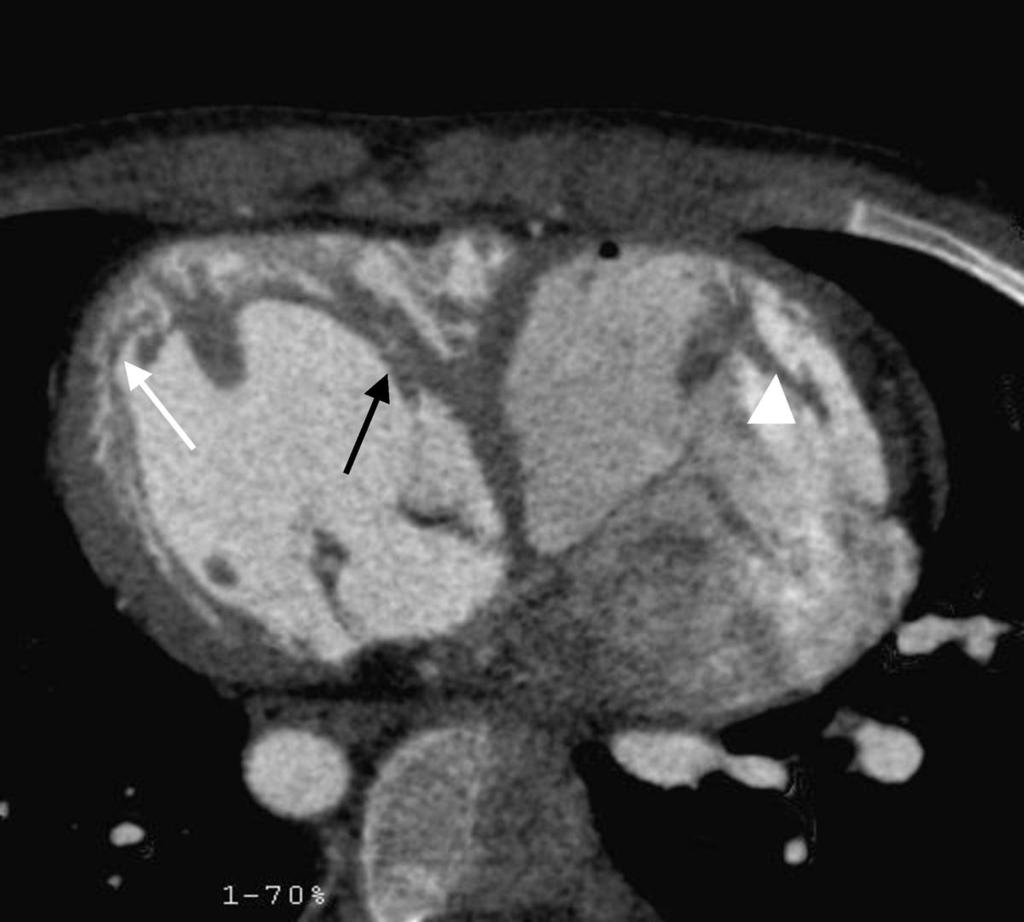 Fig. 12: In morphological right ventricle, the trabeculae are coarse(white arrow) and the papillary muscles(black arrow) attach to both free