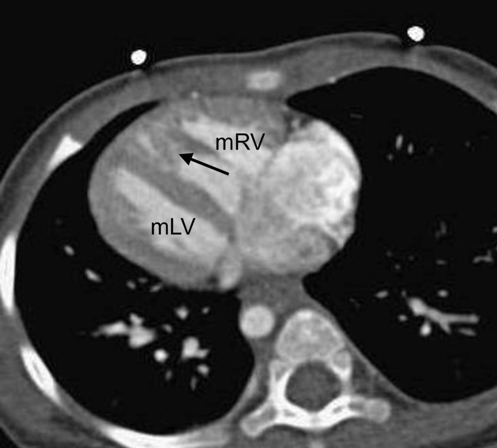 Fig. 16: This 3 year old girl(the same case as figure 15) has her morphological right ventricle(mrv) located leftward of the morphologic left ventricle(mlv), a L-loop