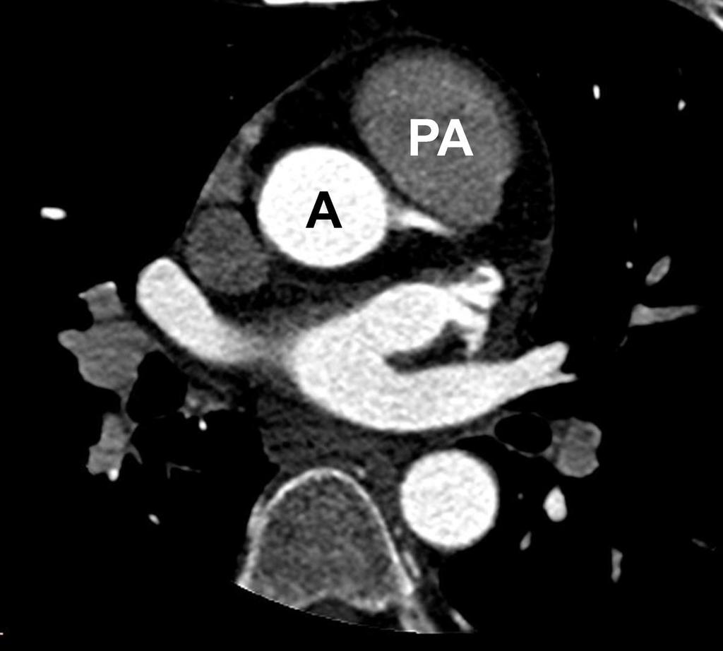 Fig. 18: Normal configuration of the great vessels: the aortic root(a) is located posterior and leftward