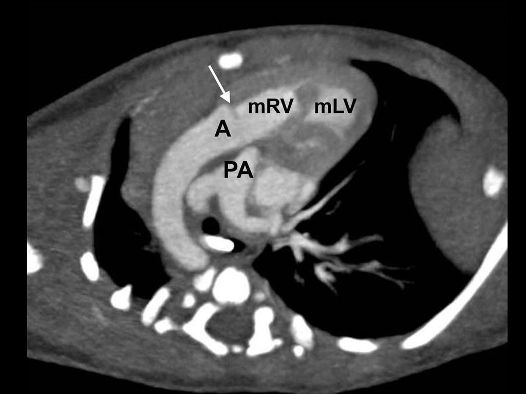 Fig. 20: This 1 day old boy with D-TGA has aorta(a) arising from morphological right ventricle(mrv) and pulmonary atresia.