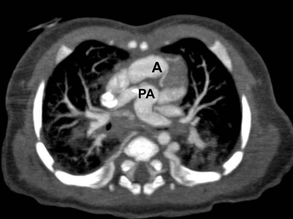 Fig. 21: This 1 week year old girl with L-TGA has aortic root(a) locates anterior and leftward to the main