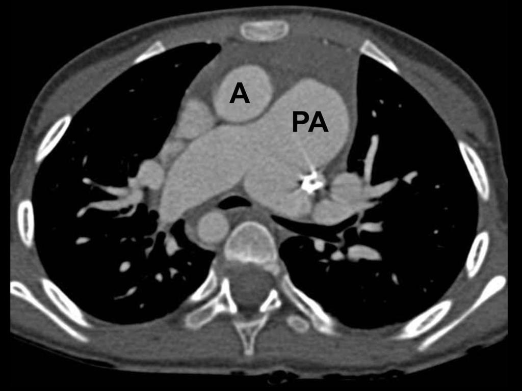 Fig. 22: This 6 year old girl with double outlet right ventricle has aortic root(a) and main pulmonary trunk(pa) arising in a
