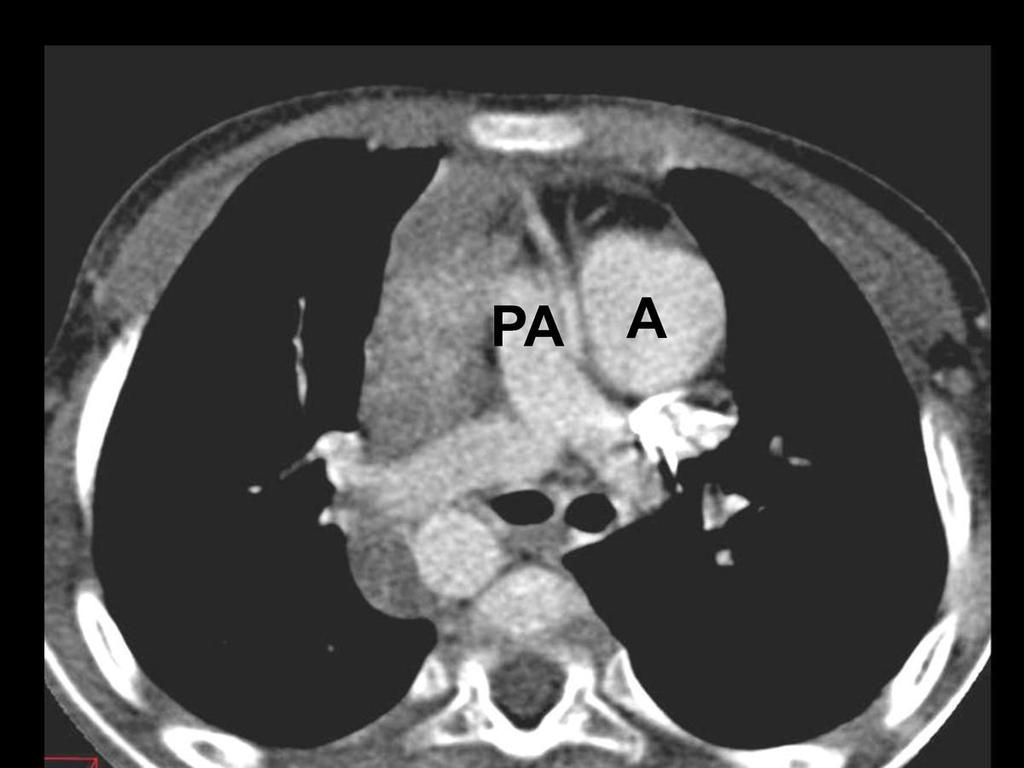 Fig. 23: This 6 year old girl with double outlet right ventricle(same case as figure 22) has aortic root(a) and main pulmonary trunk(pa) arising in a parallele plane from morphological right