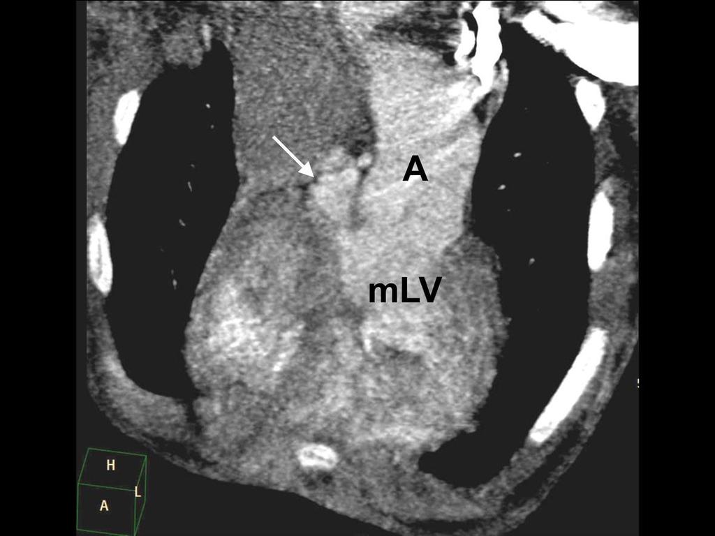 Fig. 25: This 6 year old girl with double outlet left ventricle(same case as figure 24) has aortic root(a) and