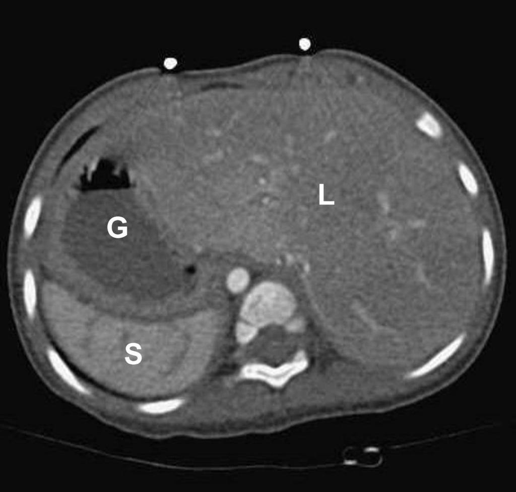 Fig. 1: This 56-year-old female has her largest lobe of liver(l) at the left side and her