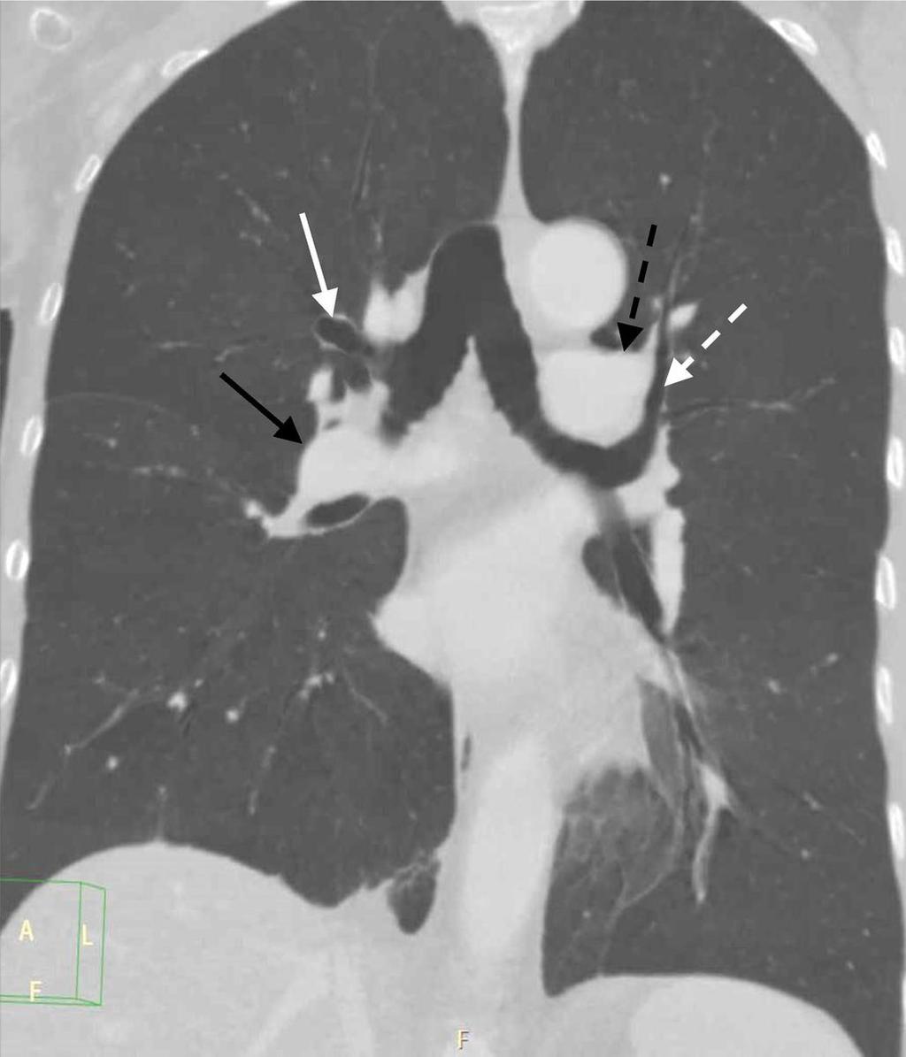 Fig. 2: Normal pulmonary sideness of broncho-pulmonary anatomy,{s,_,_}: (1) Hyparterial position of left main bronchus and eparterial position of right main bronchus(black arrow: right main pulmonary
