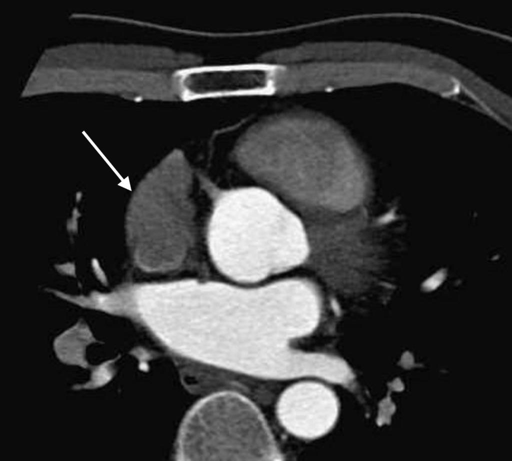 Fig. 3: Typical appearance of right atrial appendage(white arrow): blunt,