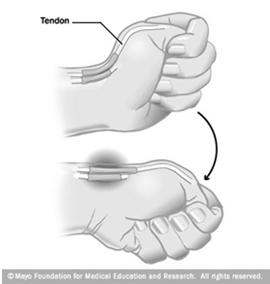 extensor tendons are extrasynovial except for zone 7