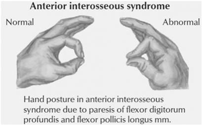 Parasthesias through median sensory distribution Dorsal and Palmar interossei Lumbricals (RF & SF) Adductor Pollicis Flexor