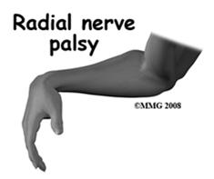 Radial nerve lesion
