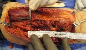 Vascular surgery did brachial artery vein repair the week