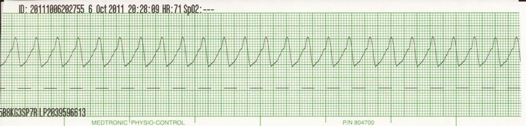 ACLS: Tachycardia Q. Nimrod Jones has a regular wide complex tachycardia with a HR of 180, but is stable. What are the suggested interventions. R.