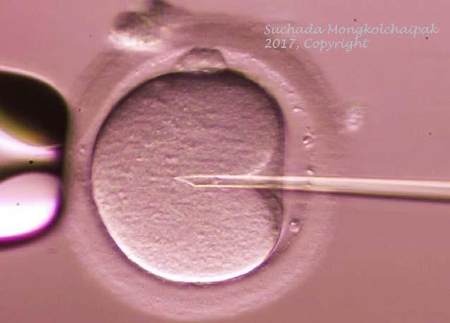 STEP 6: FERTILIZATION PROCESS(IVF/ICSI/IMSI) Low sperm quality, case of PGS, PGD: During the process of ICSI, an