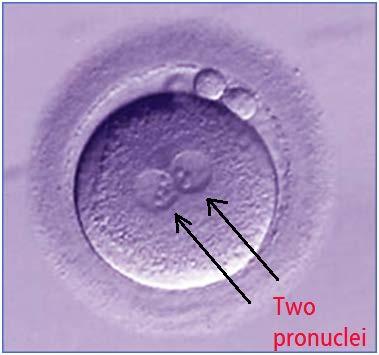 STEP 7: FERTILIZATION CHECK On the following day after fertilization, visualization of two pronuclei (male and female nucleus) confirm the fertilization in the egg
