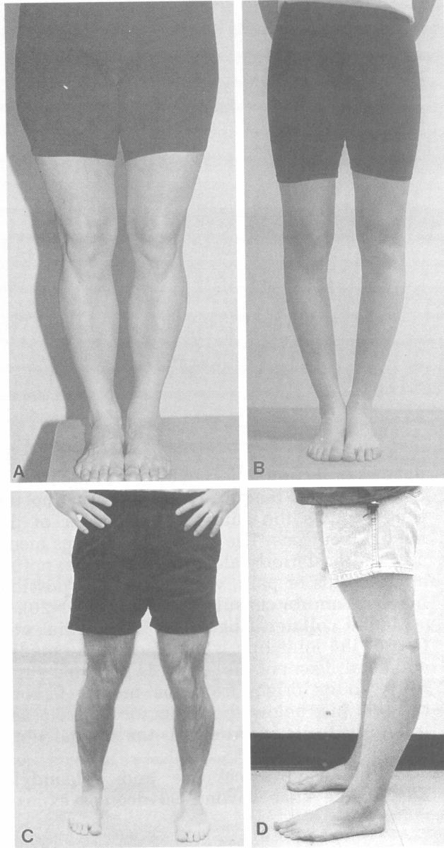 TibioFemoral Alignment What are