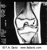 Osteochondral Defects Fractures of articular