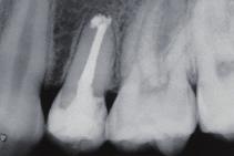 Application examples Canal is considered narrow: R25 Canal clearly visible from access cavity to apex: