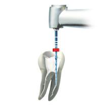 The design of the RECIPROC blue instrument allows any obstructions in the coronal third to be removed. 3 1. Estimate the working length from a preoperative radiograph. 2.