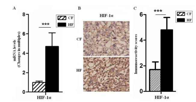 Gestational diabetes induces HIF1 expression in the