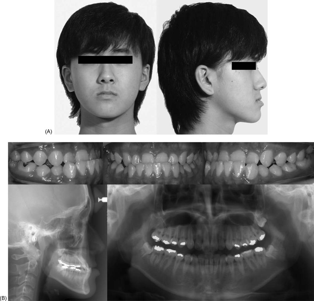 Virtual model surgery and wafer fabrication for orthognathic surgery 1307 Technology to replace the 3D-CT data of the dentition with 3D-virtual dental casts has been developed for a 3D-VMS program