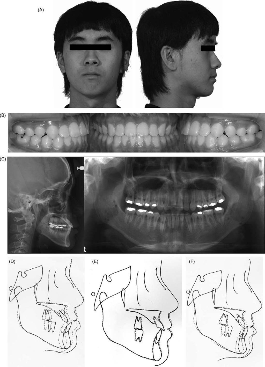 Virtual model surgery and wafer fabrication for orthognathic surgery 1309 Fig. 3.