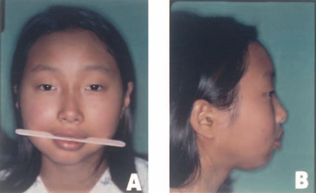 distractor was removed 8 weeks after completing the distraction. During the entire distraction process, the patient performed active mouth opening exercises and received a tolerable diet.