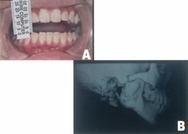 (2) Case II Fig. 1. A and B. Preoperative facial photographs showing chin deviation to the right, a retrognathic mandible, and maxillary canting. Fig. 2. A. Maximum mouth opening preoperatively, B.
