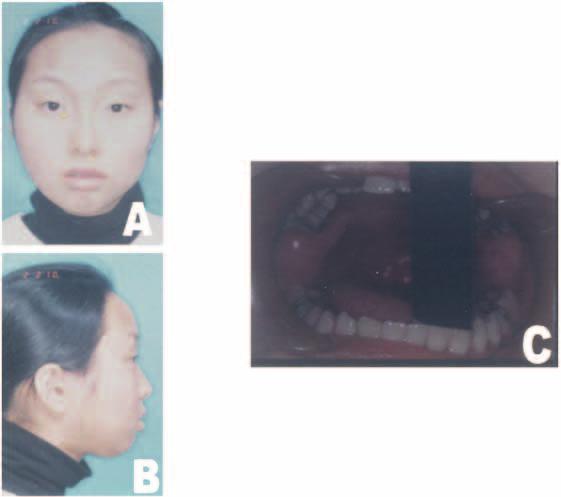 546 Yoon and Kim and at that time the patient had a maximum mouth opening of 42 mm (Fig. 8A, B, and C, Fig. 10A, B). Fig. 4. A, B, and C.