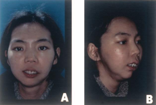 Preoperative facial photographs showing facial asymmetry, with a chin point deviation to the right, maxillary cant, retrognathic mandible, and the scars caused by previous operations.