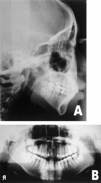 Cephalometric and panoramic radiograph at the completion of distraction (a
