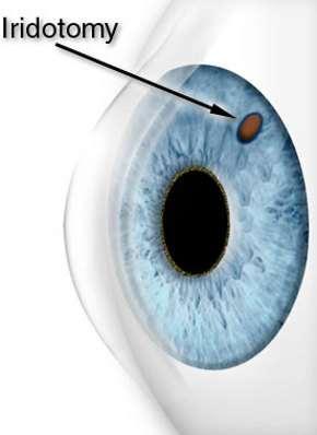 glaucoma present. The precise diagnosis of angle closure glaucoma is dependent on gonioscopy, which is where the examiner uses a special type of contact lens to view the drainage angle of the eye.
