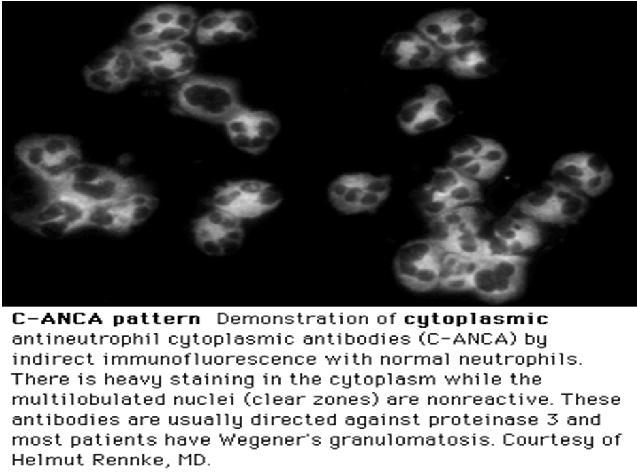 When suspecting vasculitis: canca, panca - immunofluorescent tests Proteinase-3 (PR-3), Myeloperoxidase (MPO) - ELISA ANA, Cryoglobulins CBC
